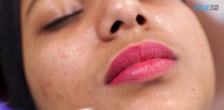 Why Go In For A Chemical Peel?